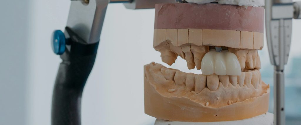 Read more about the article Using Implant Guides and Stents to Create a Perfect Smile