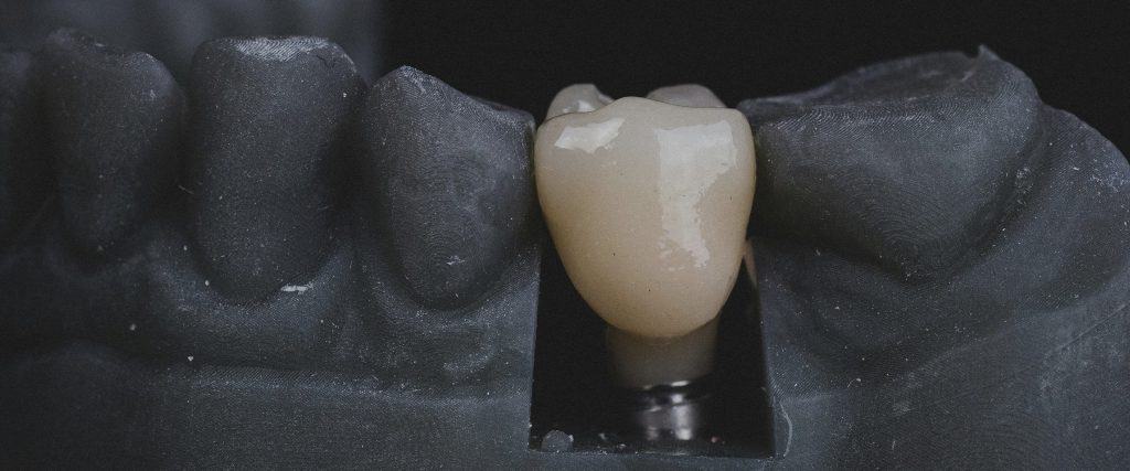 Read more about the article Why Implant Planning is Crucial to All Dental Implant Procedures